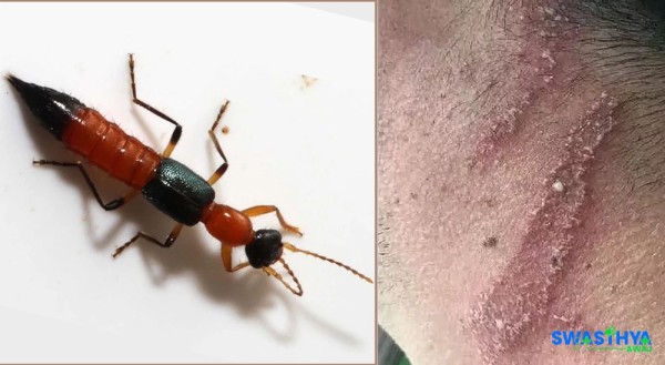 वर्षायामसँगै फैलिन थाल्यो 'नैरोबी फ्लाइ' संक्रमण, सतर्क रहन चिकित्सकको सुझाव