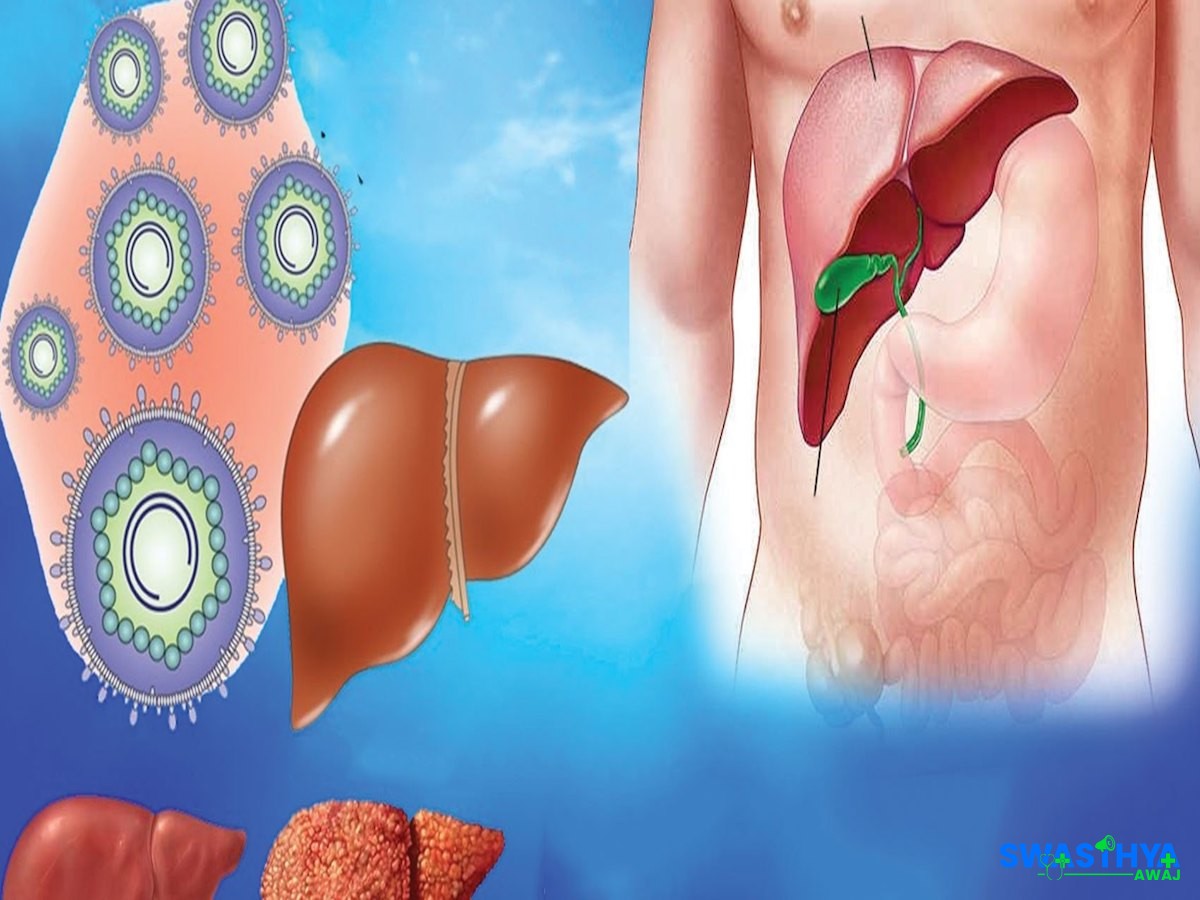 नेपालबाट भाइरल हेपाटाइटिस अन्त्य गर्न सकिन्छ : रणनीतिक प्रयास आवश्यक